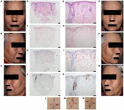 Case report: Usefulness of a picosecond Alexandrite laser therapy on atypical henna-induced Riehl's melanosis inferred from immunohistochemical analyses